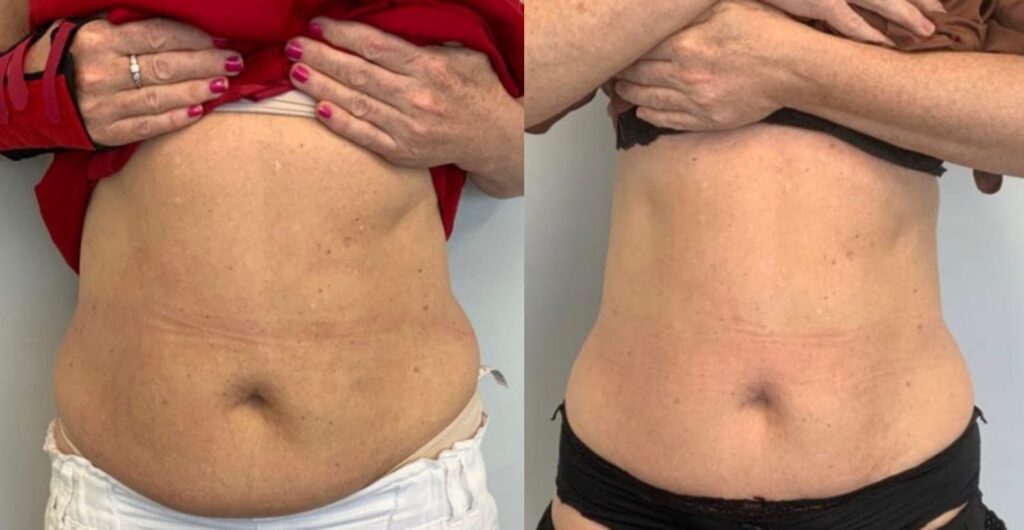 Abdomen Sculpting: Achieving a Toned Midsection