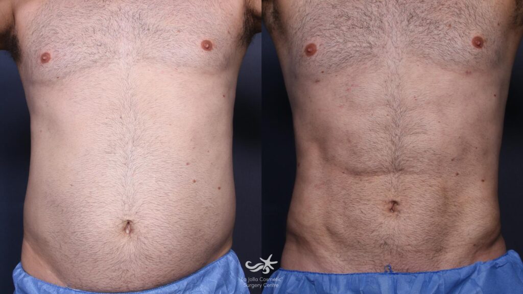 Before and after aesthetic procedures on a specific body area