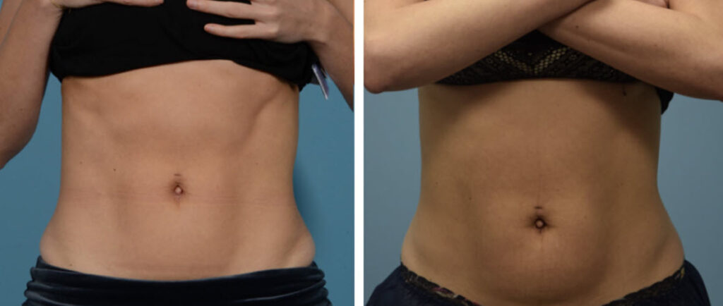 body sculpting treatment comparison